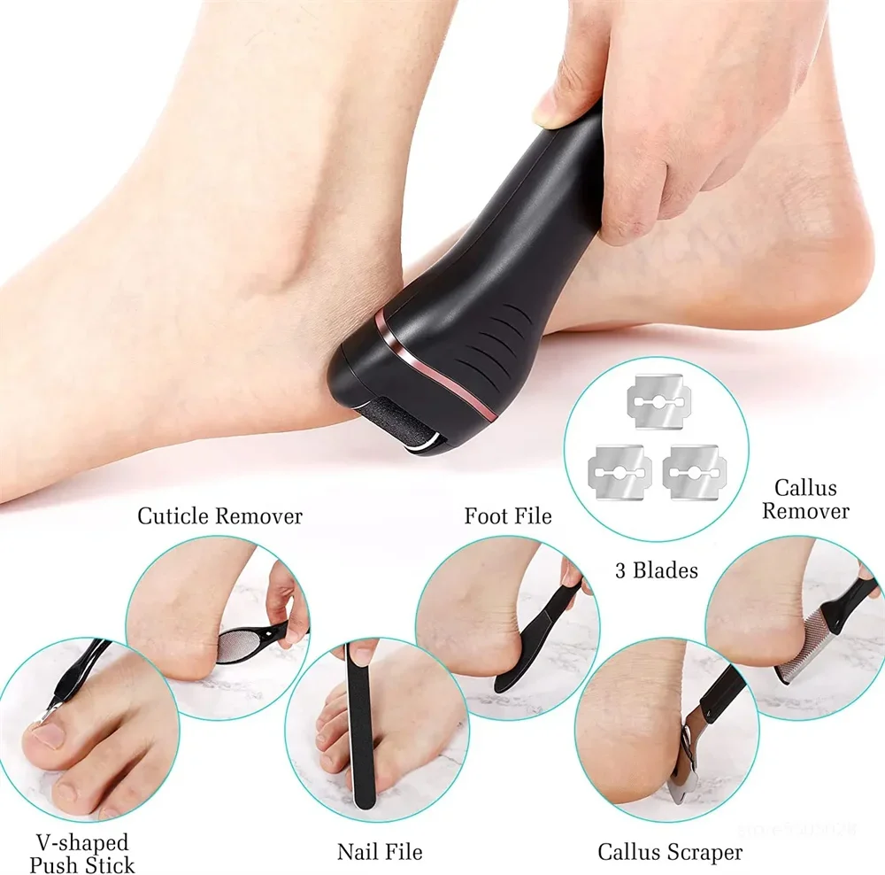 Severe dry skin before treatment with electric callus remover